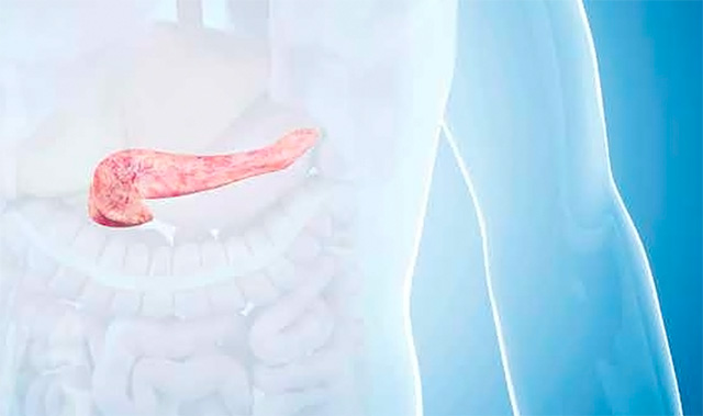 Pancreatic Cystic Lesions