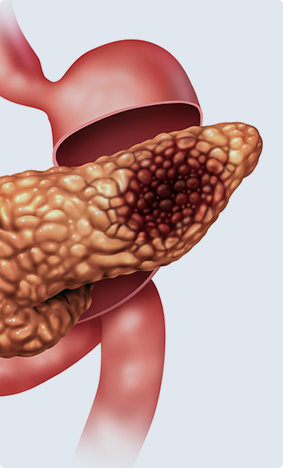 Pancreatitis