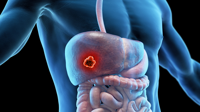 What Are the Early Signs of Liver Cancer and When Should I See a Specialist?