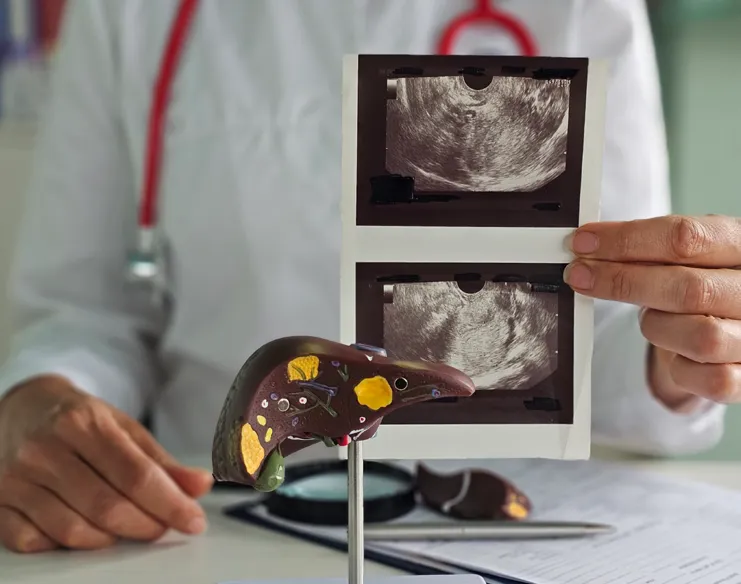 How Do Doctors Decide on Liver Cancer Treatment?
